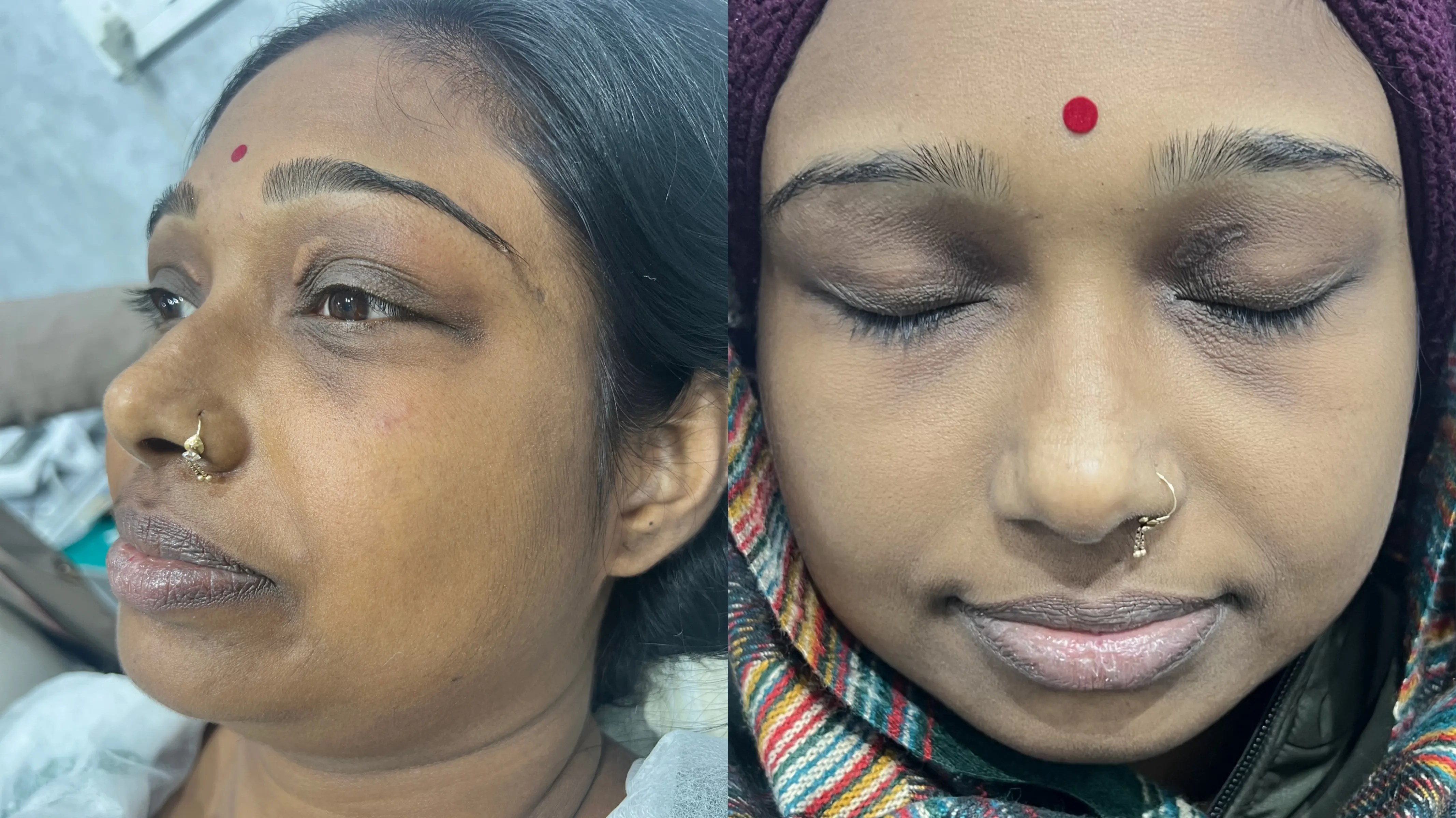 White Mark Above Eyes Removal